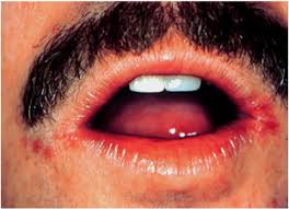diseases of the lips sciencedirect