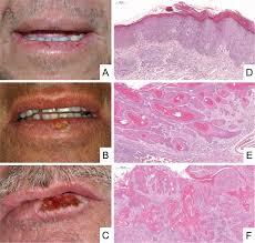 lip squamous cell carcinoma