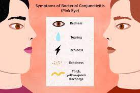 bacterial conjunctivitis pink eye