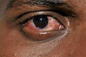 madras eye infection