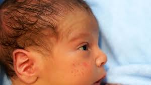 baby acne faq symptoms treatment and