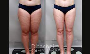 liposuction thighs before after before