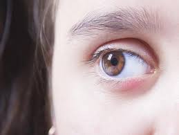 swollen eyes or eyelids