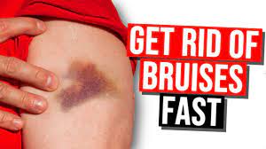 how to get rid of bruises you