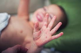 hand foot mouth disease hfmd in