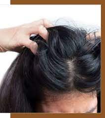 anti dandruff treatment for scalp