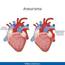 Sapevi che tutte le persone hanno una disposizione arteriale simile? Aneurisma Sintomi Significato E Prevenzione