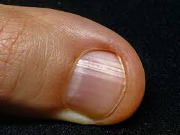 curved nails causes of spoon nails and