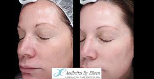 microneedling aesthetics by eileen