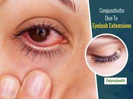 eyelash extensions can cause