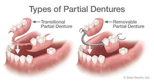 I understand that removable prosthetic appliances (partial dentures) and full there is a charge for relining dentures. Dentures In Garland Ut Dustin V Goodwin Dds Pc