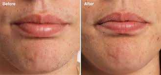 diode laser hair removal treatment