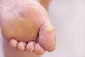 how to safely remove a foot wart at