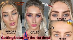 forehead frown brow lift