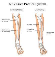 nuvasive precice system limb length