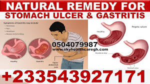 home remes for peptic ulcer in ghana
