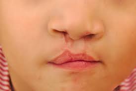 cleft lip and palate medlineplus