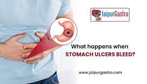 what happens when stomach ulcers bleed