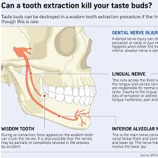 complicated wisdom tooth cases