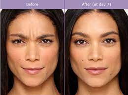 botox vs xeomin to smooth out wrinkles