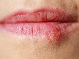 all you need to know about cold sores