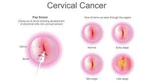 pap test for cervical cancer prevention