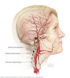 Image result for icd 10 code for stenosis of bilateral carotid arteries