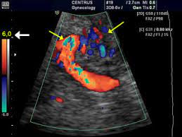 ultrasound scan in pregnancy color