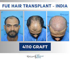 cost of hair transplantation in india