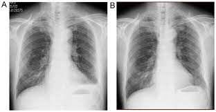 Asbestosis is a type of. Double Cancer Comprising Malignant Pleural Mesothelioma And Squamous Cell Carcinoma Of The Lung Treated With Radiotherapy A Case Report