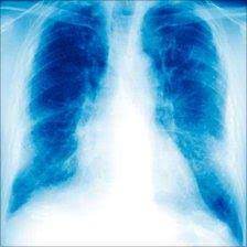 As like infiltration of the pleural lining mesothelioma is very painful and will lead you to the hospital right away. Mesothelioma Asbestos Victims To Get 350m Compensation Bbc News