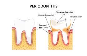 treatments for periodontal disease to