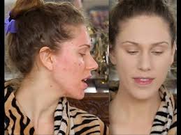 acne scar foundation routine full