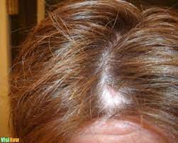 will low thyroid cause hair loss
