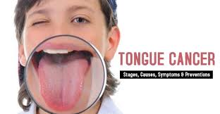 tongue cancer ses causes symptoms