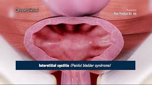 intersial cysis video
