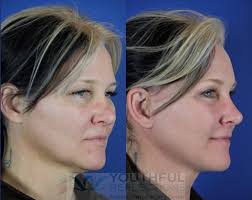 recovery from facelift surgery do s