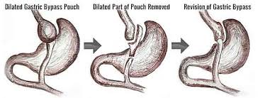 revision gastric byp weight loss surgery