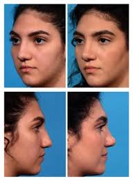 rhinoplasty before and after photos