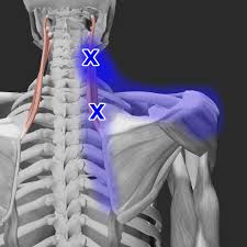 acupuncture for levator scae pain