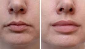 Image result for How Much Does Lip Fillers Cost In South Africa