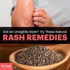 natural rash remes