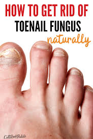 home remes for nail fungus on