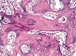 Malignant cells known as paget cells are a telltale sign of paget disease of the breast. Pathology Outlines Paget Disease