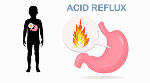 home remes for acid reflux that are