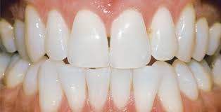 Dental Professional Teeth Whitening Philips Zoom