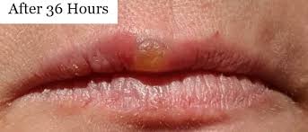 cold sores treatment in two days dr