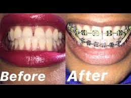While surgery and tooth extractions may be recommended for some severe cases, you can still rest assured that braces are often the most effective treatment for the majority of people with underbites. Braces For Underbite Youtube
