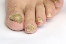 toe talk fighting fungus ugly truths