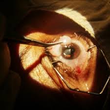 cataract surgery aftercare what to